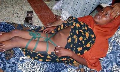 A Female Genital Mutilation victim