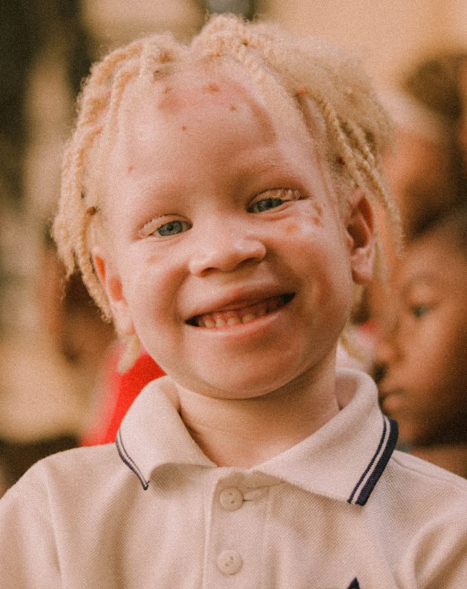 Girl with albinism